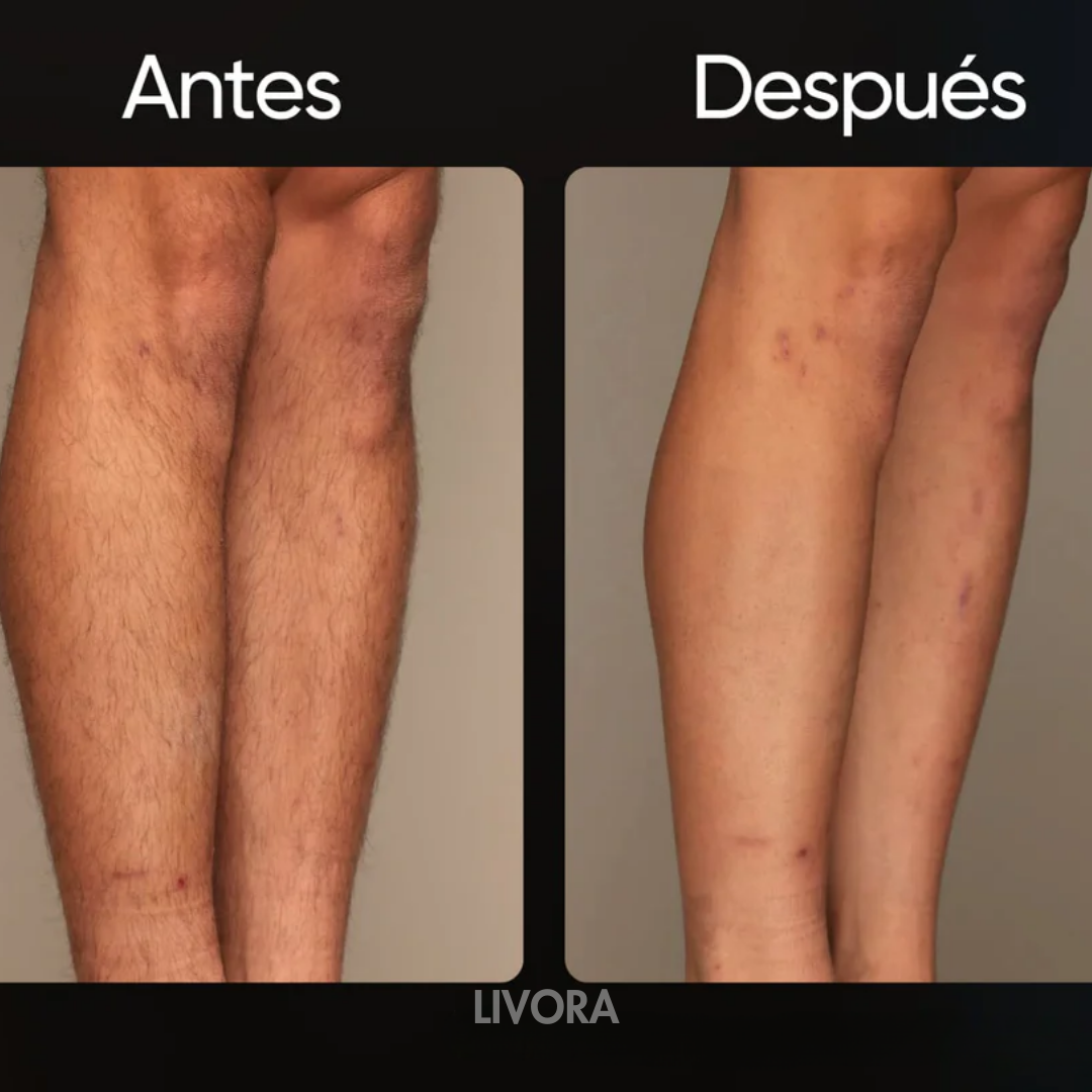 SkinLiv Pro | Láser Permanente